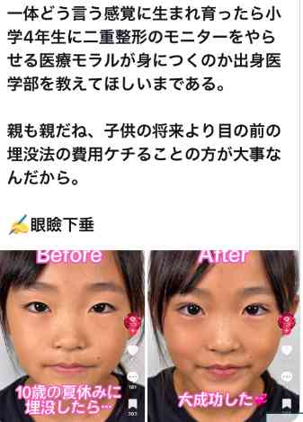 「美容整形の後遺症」鼻が変形、慢性痛にしびれ、壊死に死亡例も…5年で5倍!現場から医師の警告