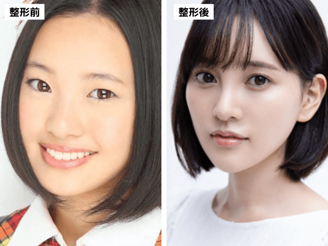 《メンタルを保つため美容整形に走った》アイドル時代に総額1000万円以上を費やした元HKT48・兒玉遥の「後悔」