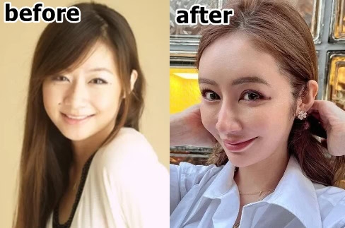 「鼻変わりましたね」の声も…元EXILE黒木啓司の妻・宮崎麗果、整形告白&ダウンタイム公開 過去に整形説を否定