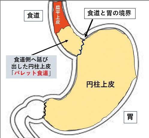 逆流性食道炎・バレット食道