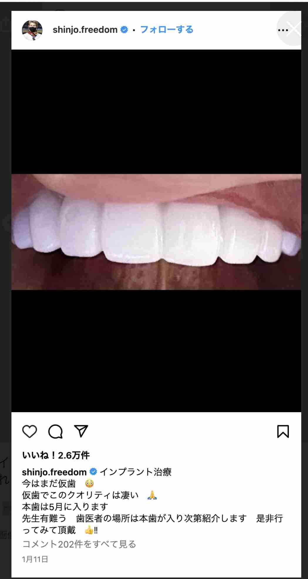 総額は3億5000万円！　整形美女・ヴァニラが明かす“トラウマ級”の凄絶手術　「頭皮をめくって人工の骨をおでこに…」　脂肪を溶かす注射は「月に200万円かかる」