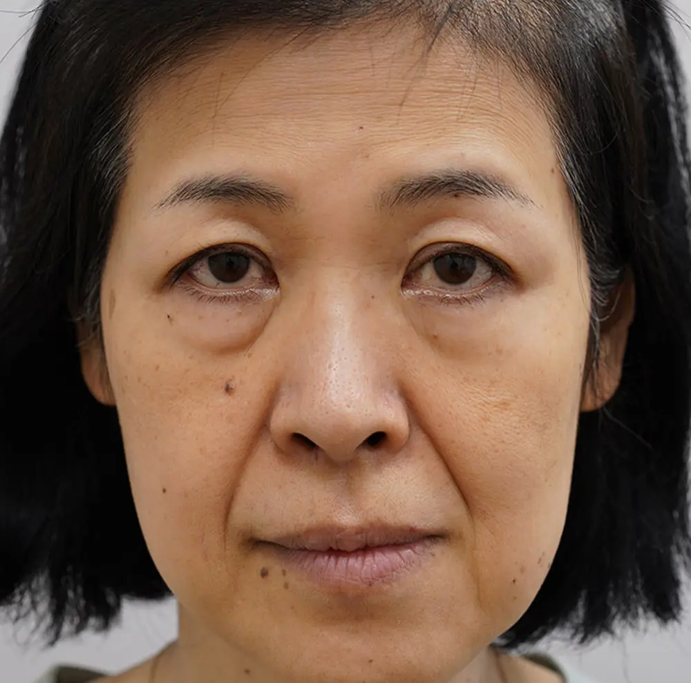 顔のたるみが辛い