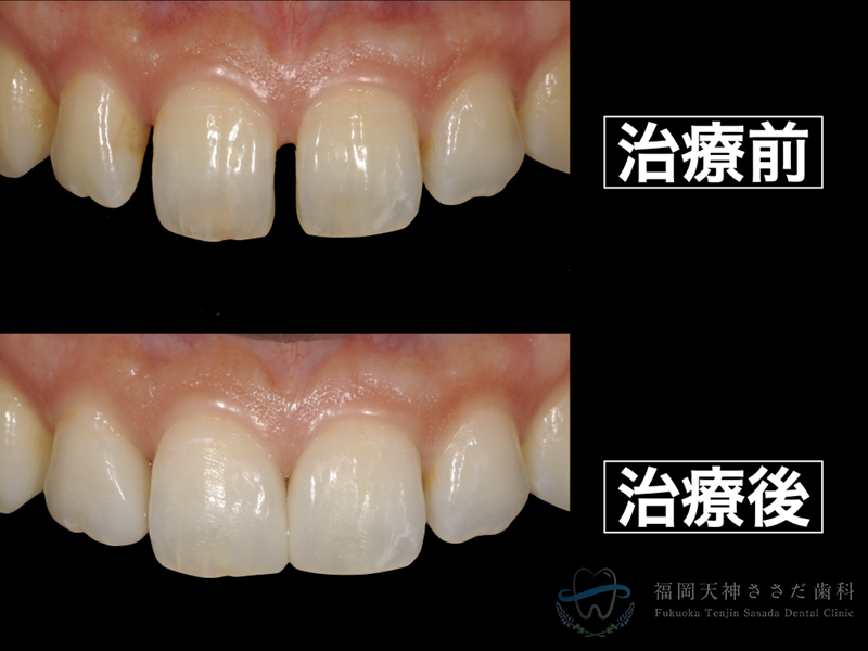 【歯】ダイレクトボンディングについて【すきっ歯】