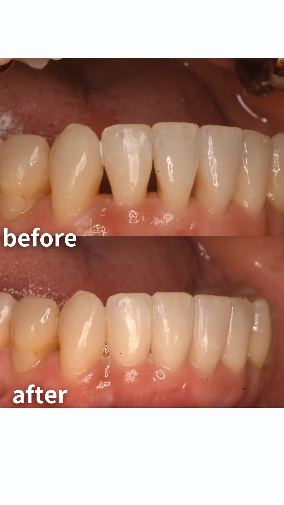 【歯】ダイレクトボンディングについて【すきっ歯】