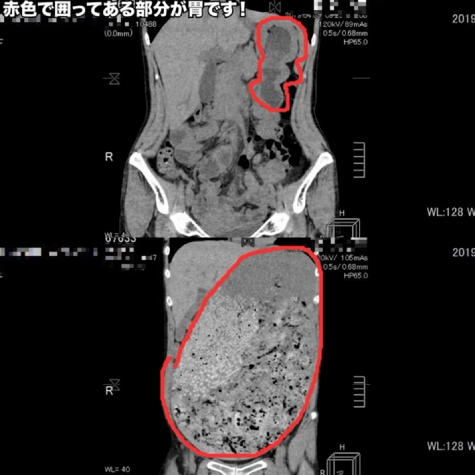 大食いYouTuber・はらぺこツインズ、活動休止を報告　小野あこ即時入院、小野かこ体調不良