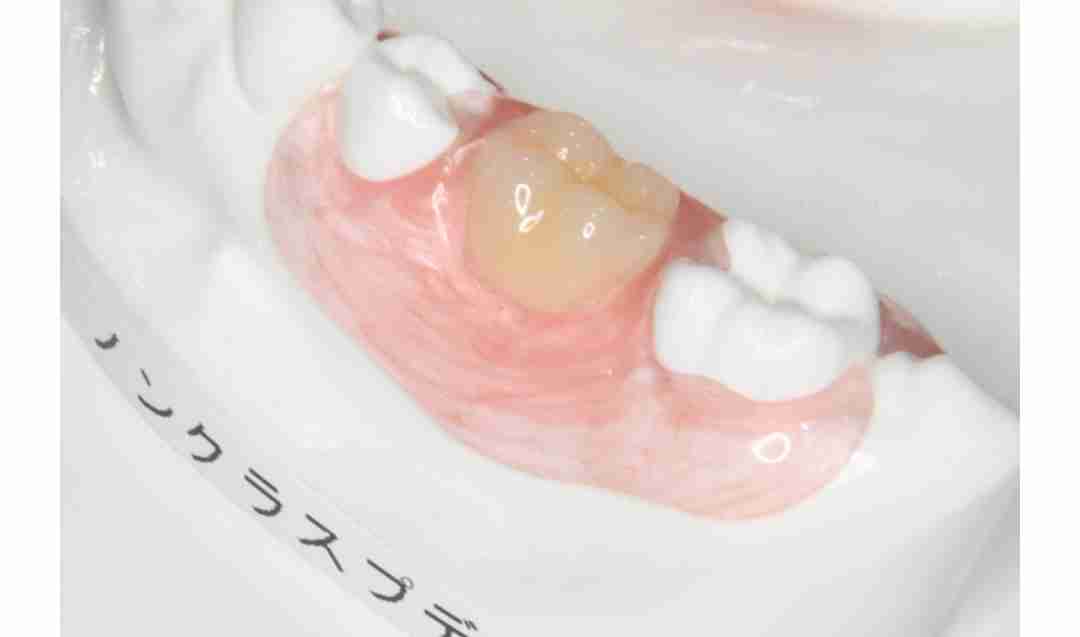 入れ歯の人いますか?