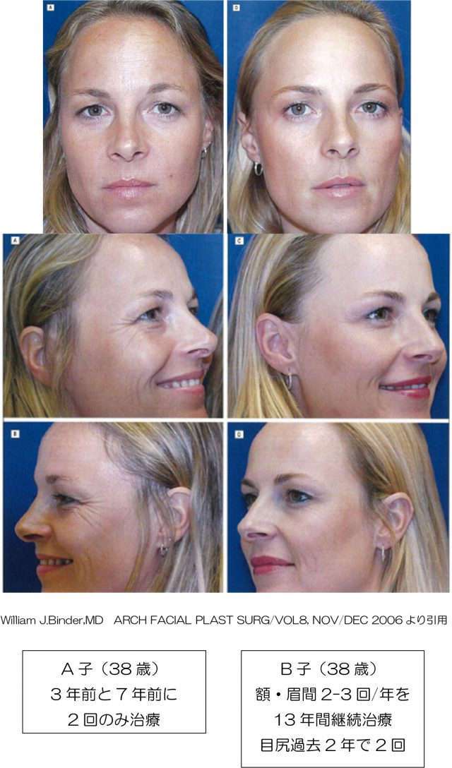 何歳からボトックス打つ？