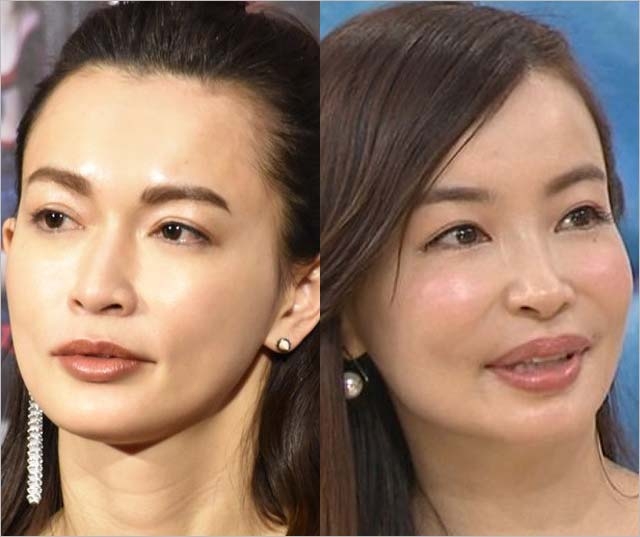 何歳からボトックス打つ？