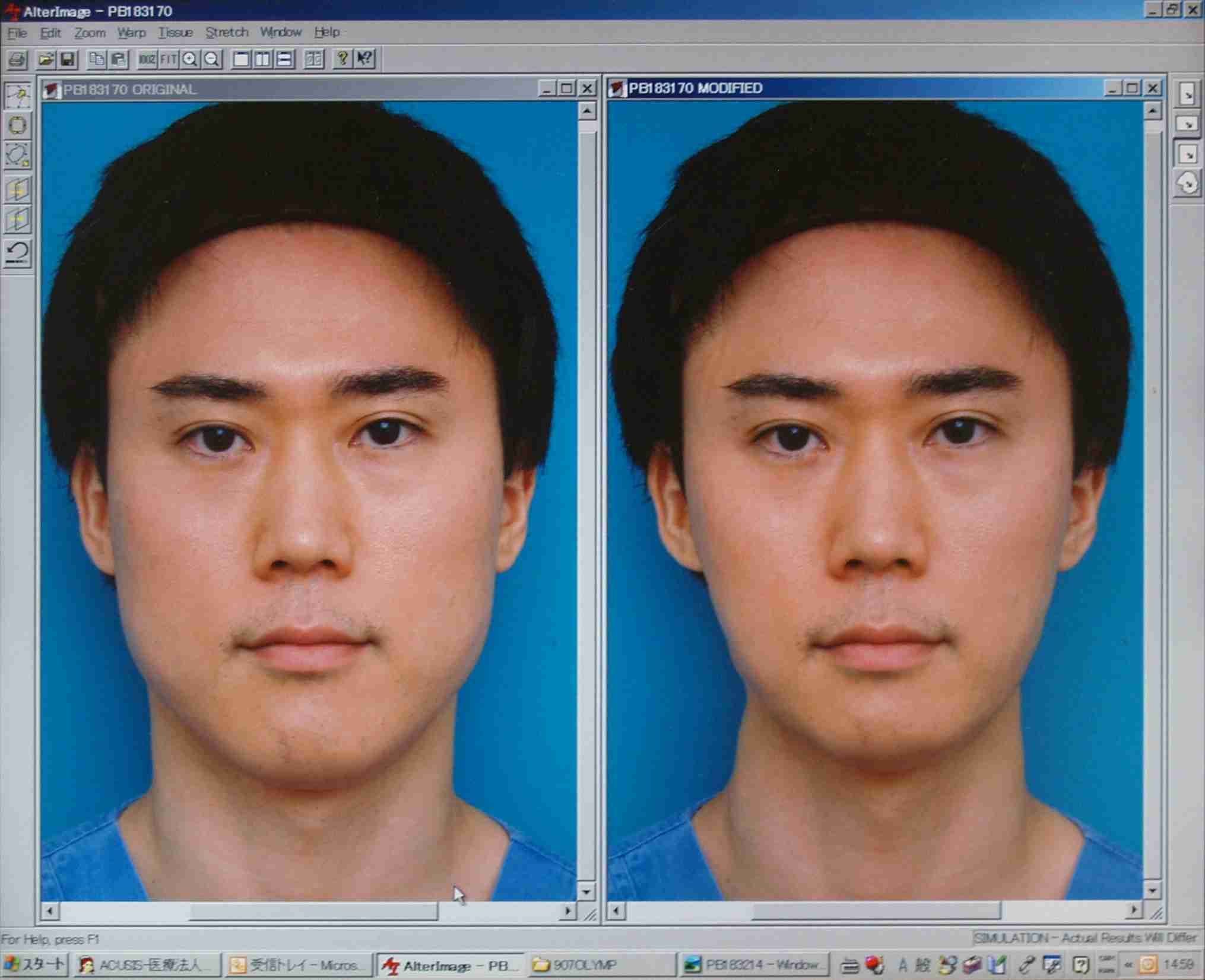 何歳からボトックス打つ？