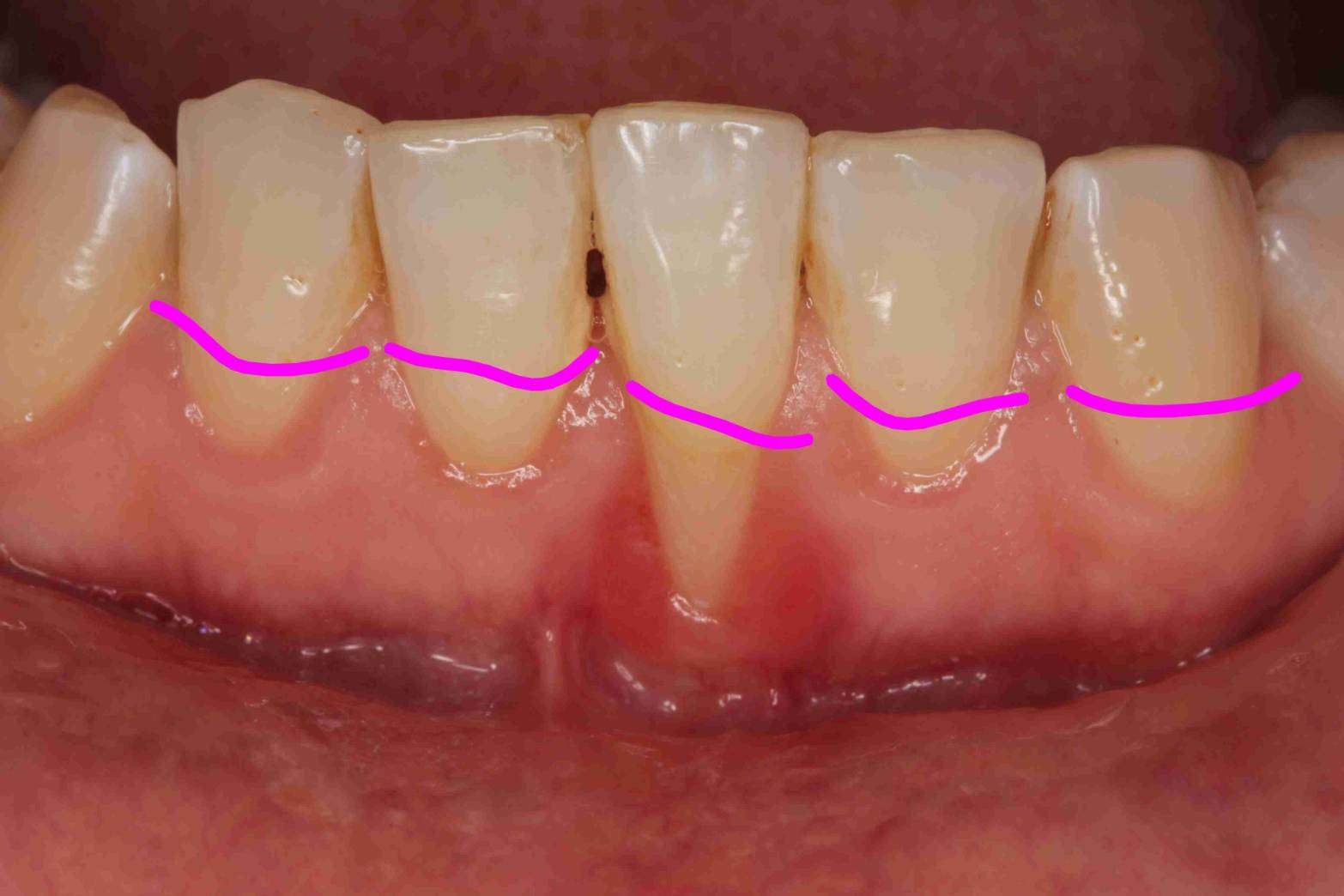 歯茎がものすごく下がってきた