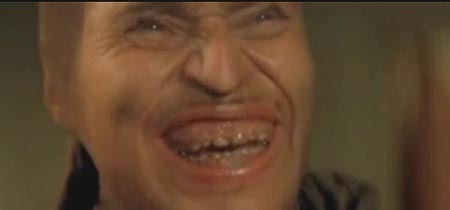 歯茎がものすごく下がってきた