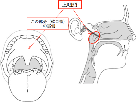 膿栓(臭い玉)