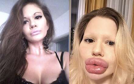 【閲覧注意】ヒアルロン酸注射に400万円使ったブルガリア女性（28）、周囲の心配よそに「たらこ唇」継続に意欲