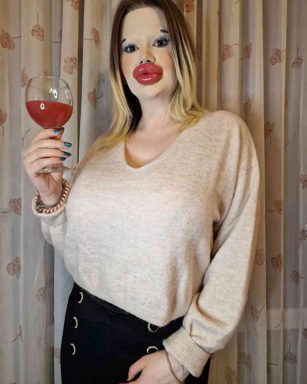 【閲覧注意】ヒアルロン酸注射に400万円使ったブルガリア女性（28）、周囲の心配よそに「たらこ唇」継続に意欲