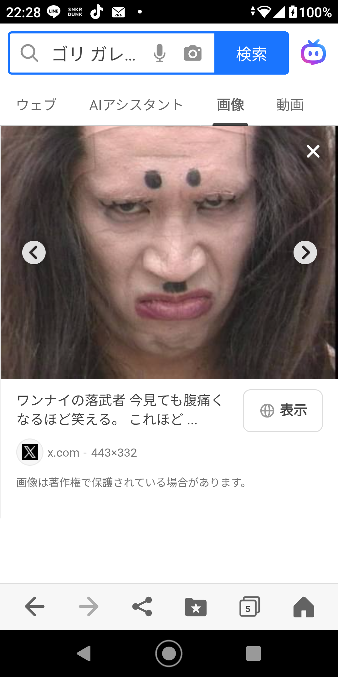 【閲覧注意】ヒアルロン酸注射に400万円使ったブルガリア女性（28）、周囲の心配よそに「たらこ唇」継続に意欲