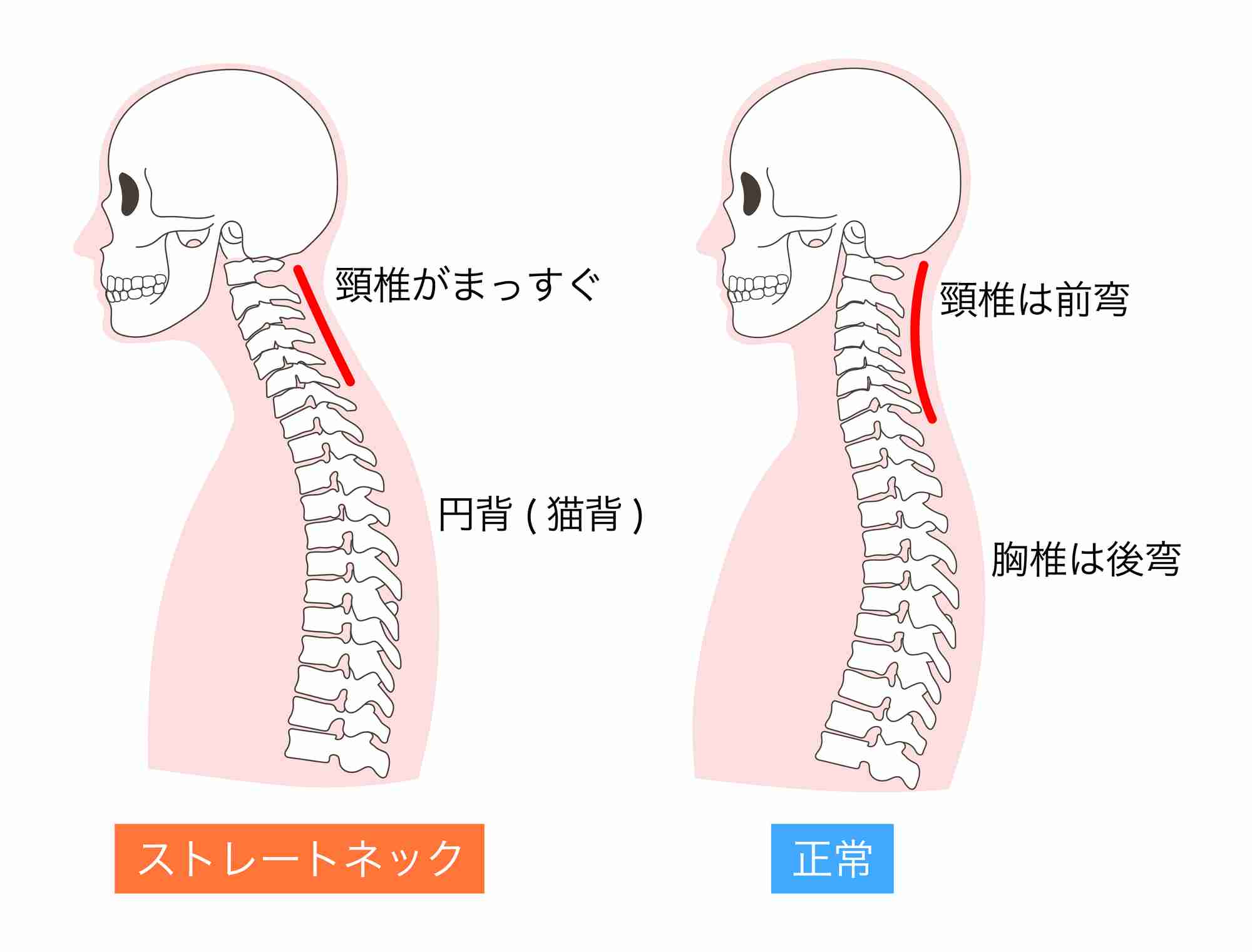 20歳以上の40％とも…現代病「ストレートネック」　スマホやパソコンの使い過ぎで首や頭に痛み…メカニズムや予防法を専門医が解説