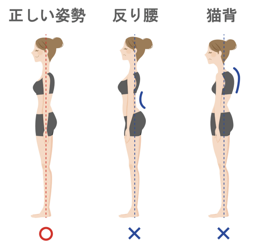自力で反り腰治す人いる?