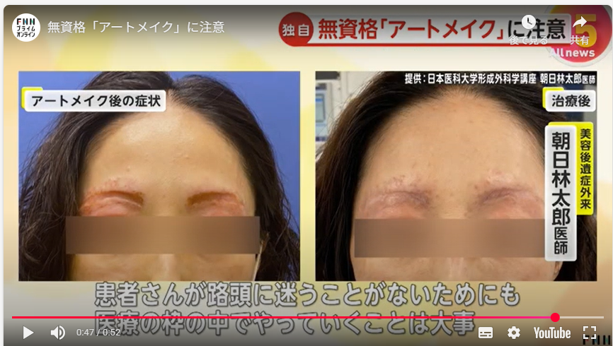 【独自】無資格「アートメイク」警察に相談を！厚労省が自治体に通知　美容後遺症外来の医師「医療の枠の中でやること大事」
