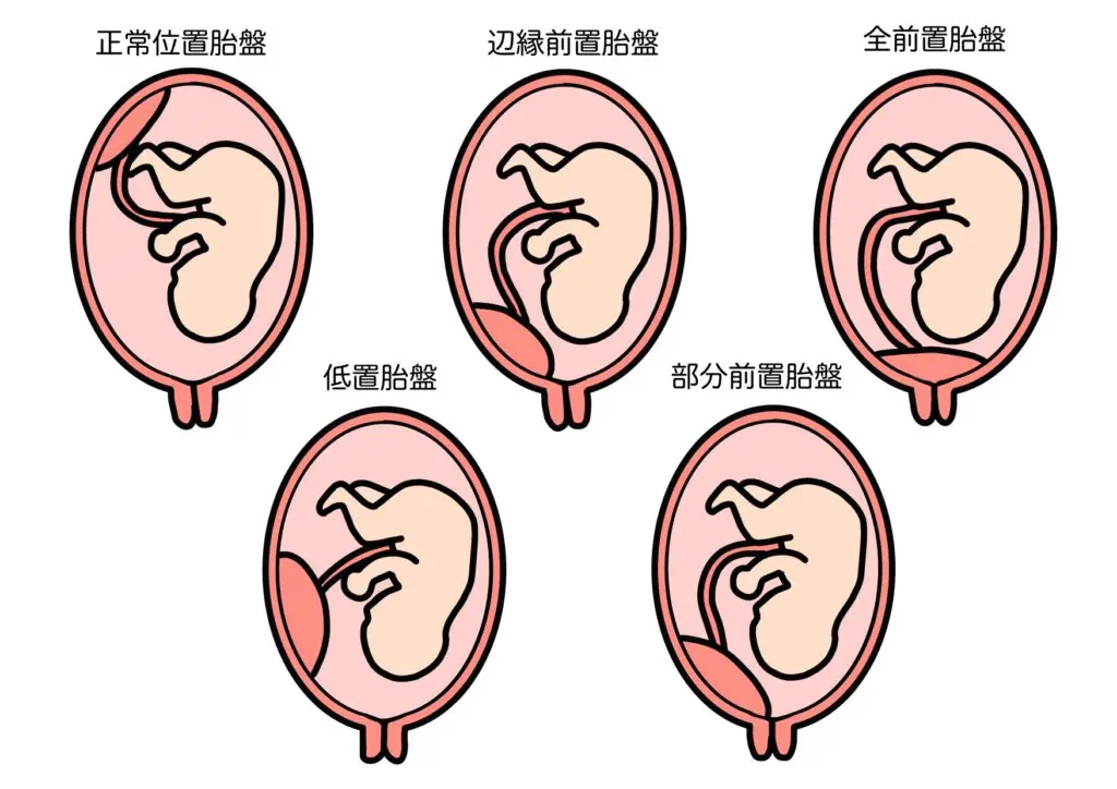 低置胎盤だった方！！