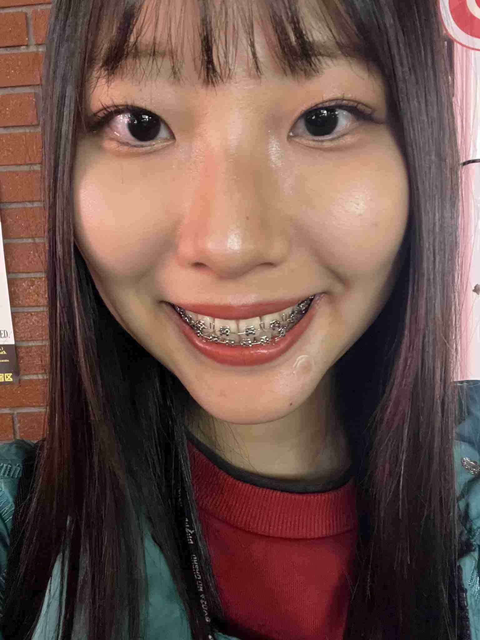 ワイヤー表側歯列矯正について語るトピ