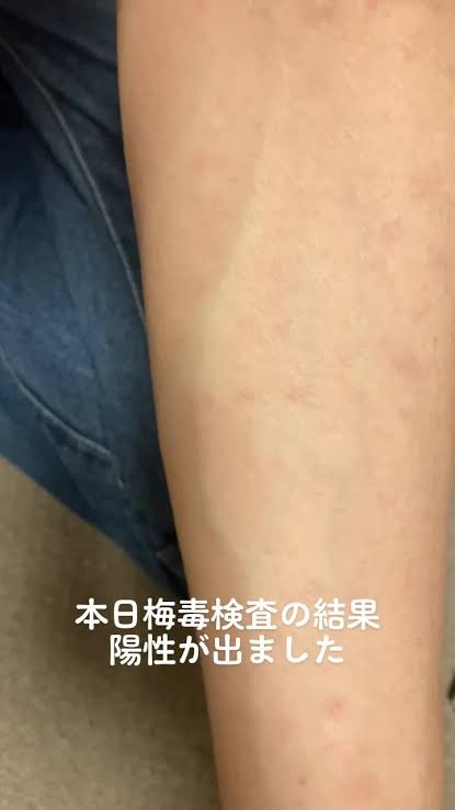 性感染症「梅毒」が全国で急増 SNS、マッチングアプリでの出会いが一因か 地方でも拡大…男性20〜40代、女性20〜30代に多く 長野県で“過去最多”4年連続更新