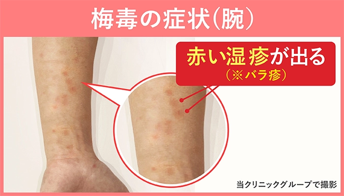 性感染症「梅毒」が全国で急増 SNS、マッチングアプリでの出会いが一因か 地方でも拡大…男性20〜40代、女性20〜30代に多く 長野県で“過去最多”4年連続更新