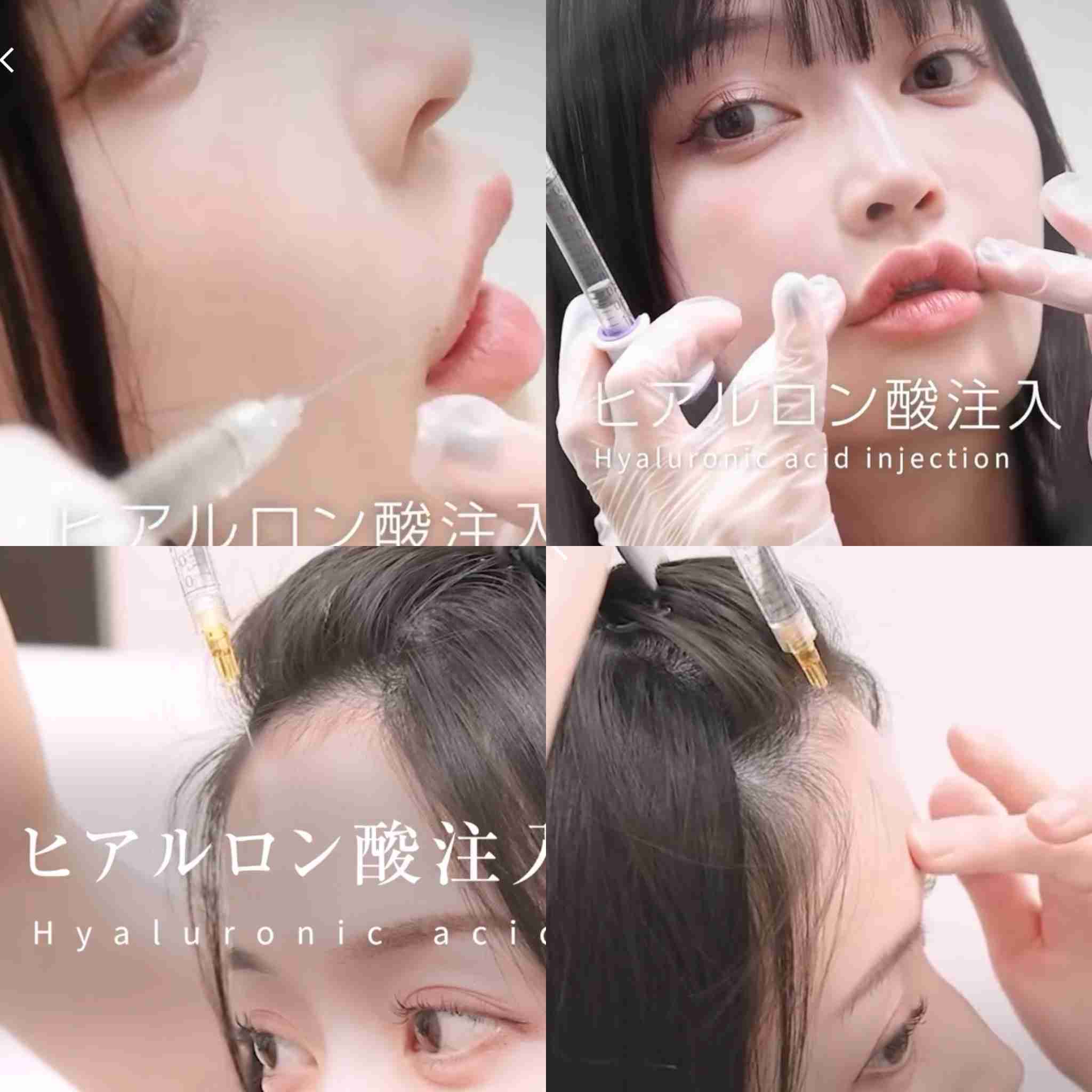 【ヒアルロン酸】経験者、検討してる方