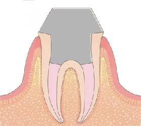 保険適用で根管治療した方、治療中の方