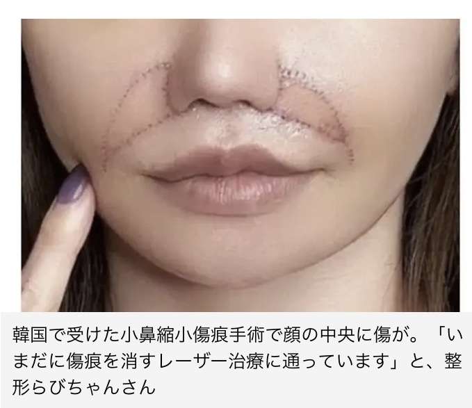 「目の下のくま取り治療が原因で失明しかけた人も」片目縮小、顔がボコボコ…美容整形によるトラブルが急増しているワケ