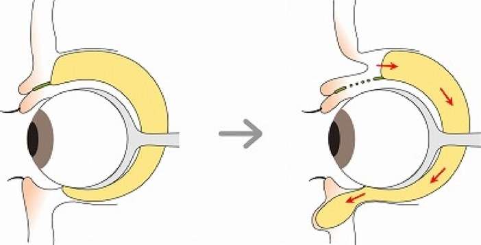 「目の下のくま取り治療が原因で失明しかけた人も」片目縮小、顔がボコボコ…美容整形によるトラブルが急増しているワケ
