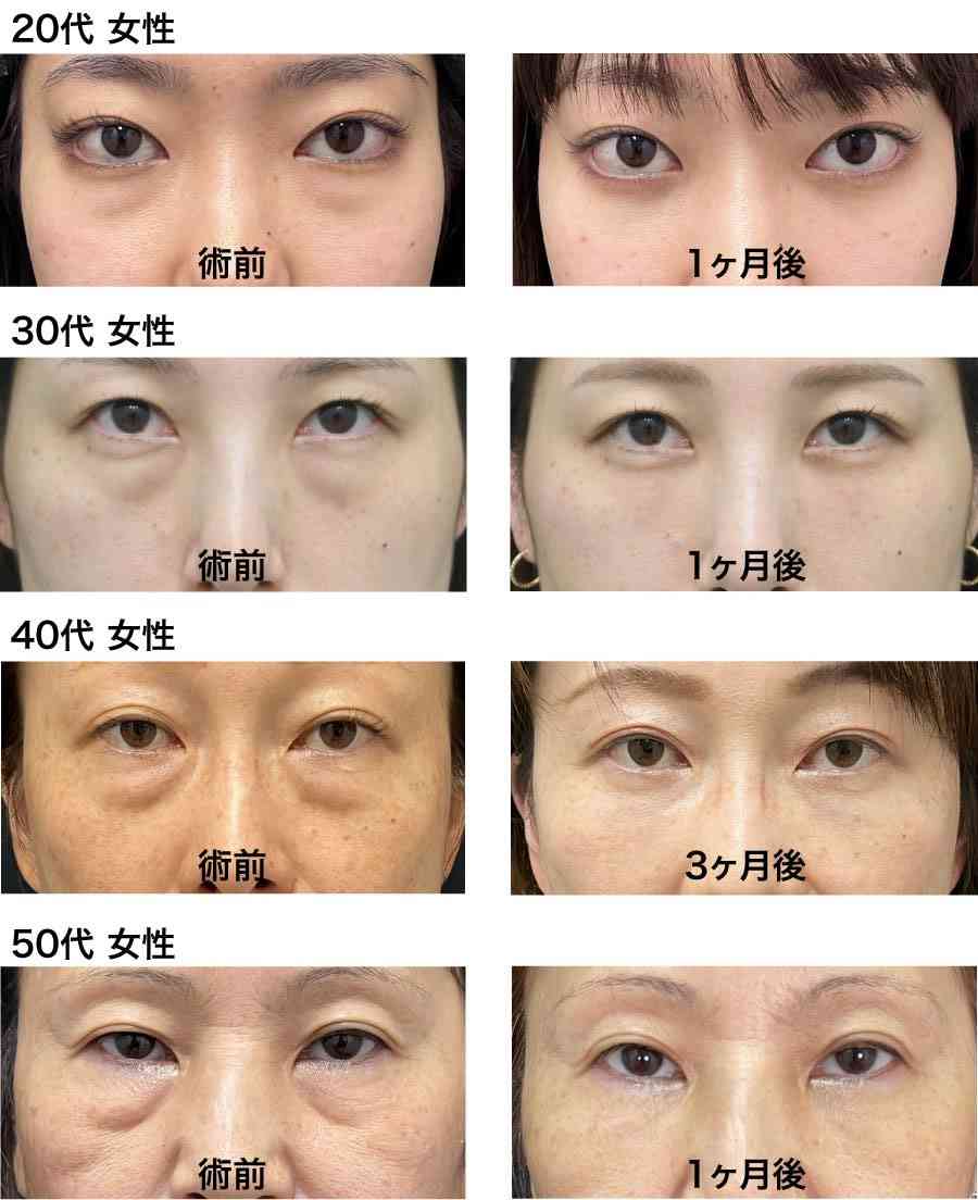 「目の下のくま取り治療が原因で失明しかけた人も」片目縮小、顔がボコボコ…美容整形によるトラブルが急増しているワケ