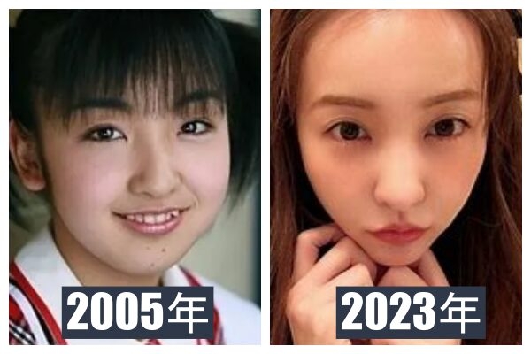 旦那にバレずに二重(埋没)した方！