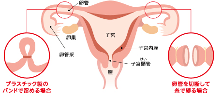 卵管結紮するかしないか