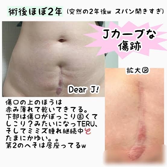 帝王切開の傷跡が萎えると言われた