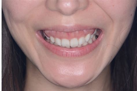 マスク美人だねと言われた