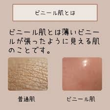 【至急】ビニール肌の治し方・期間