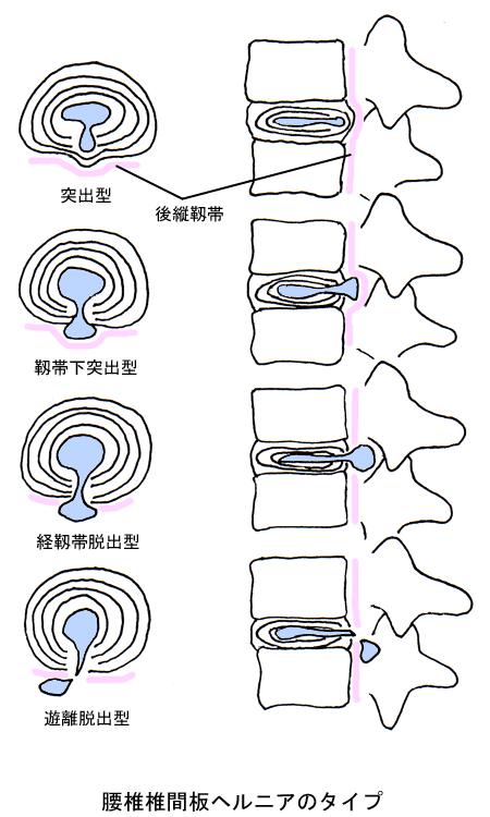 腰椎椎間板ヘルニアの方、語りませんか？