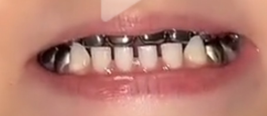 子どもの虫歯割合“過去最少”に！幼稚園は初めて2割下回る　視力1.0未満は学年上がるごとに増加傾向　文科省「学校保健統計調査」