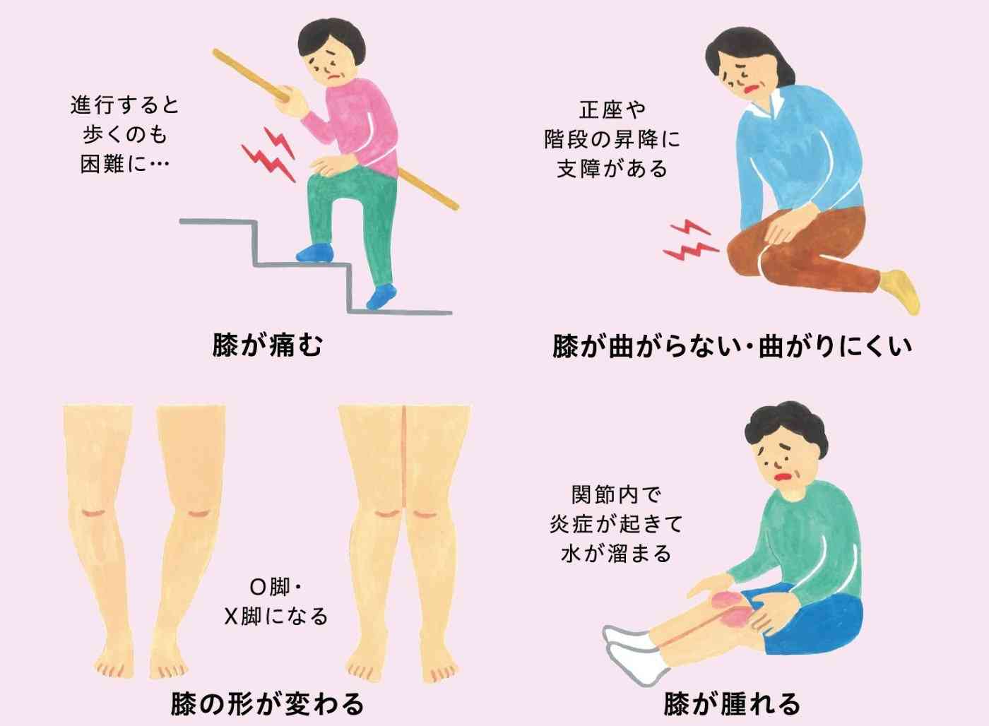 変形性膝関節症