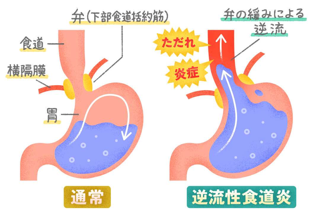 【病気】逆流性食道炎（胃食道逆流症）について知っていること