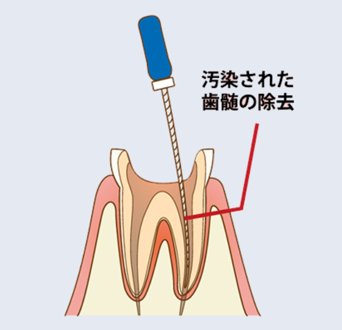 根管治療 神経治療 やり直し