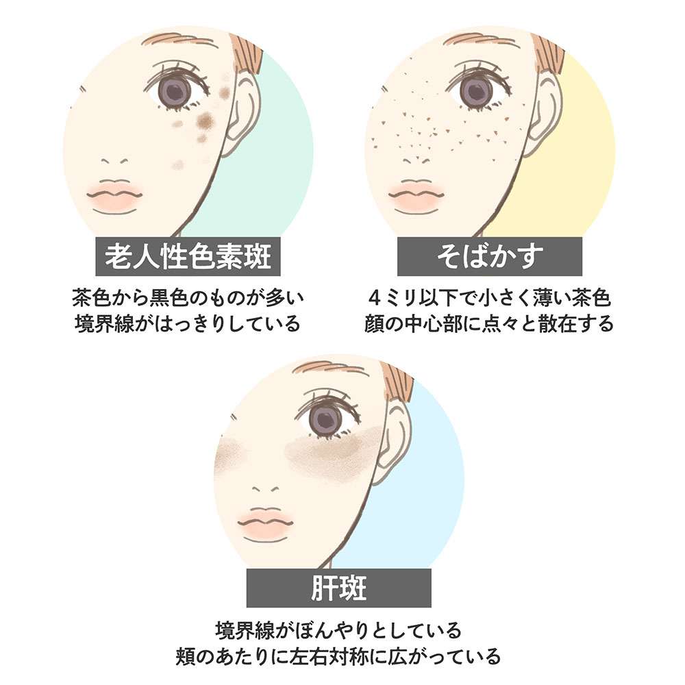 顔のシミが消えない（シミ取り全般トピ）
