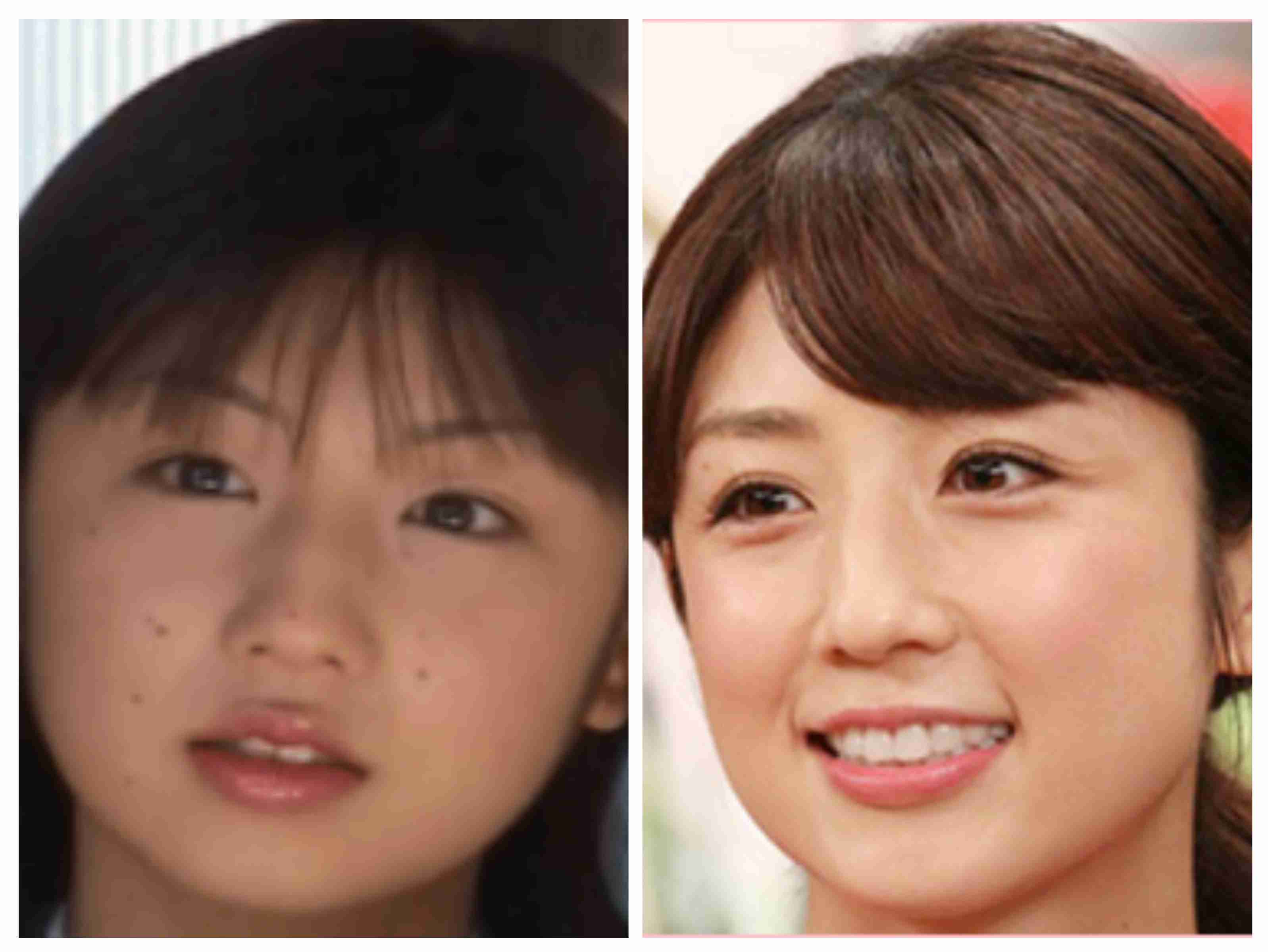 ほくろの除去【施術】