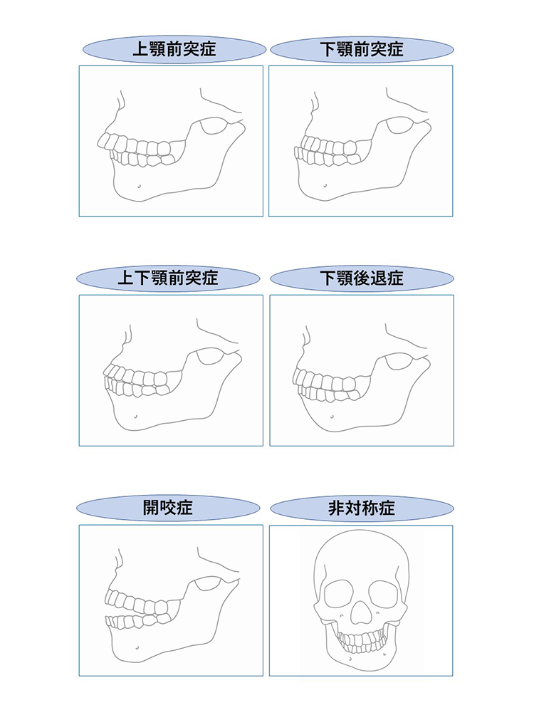 しなこ、両顎の骨切り手術を報告・術後の姿公開「10年くらい前に気づいてからずっとコンプレックスだった」顎変形症で5年前から矯正