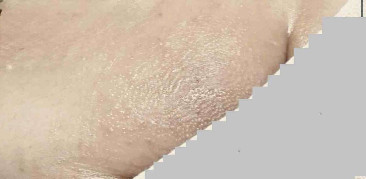 永久脱毛したことがない