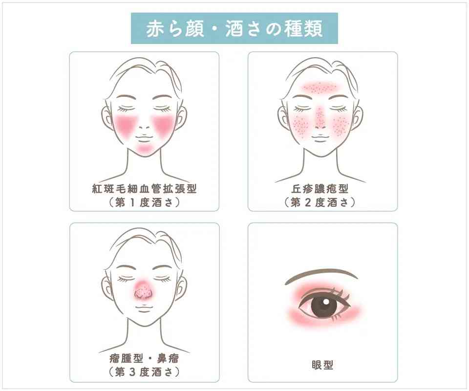 酒さ(しゅさ)と診断された方