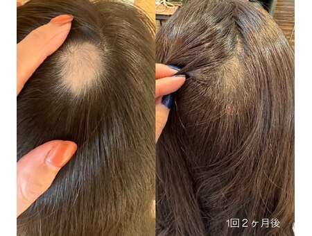 女性ハゲに効くもの教えて