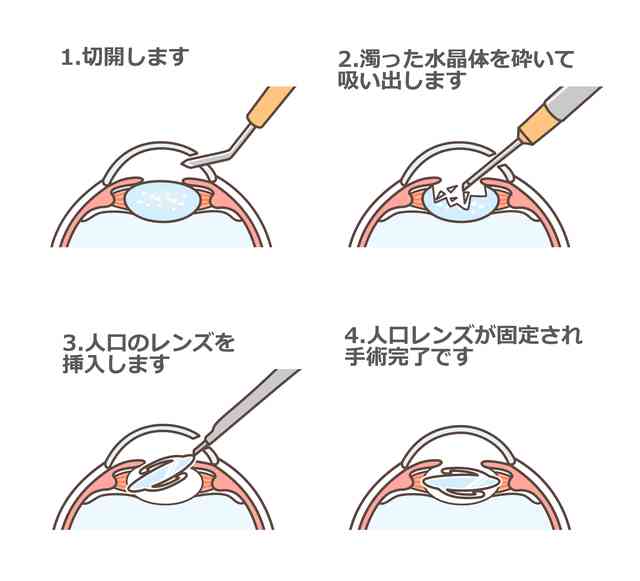 コンタクトをやめたい