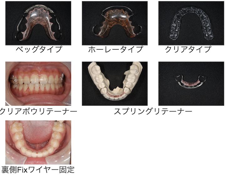 リテーナー期間