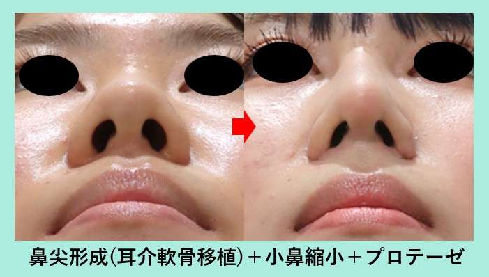 鼻毛の悩みをなぐさめあいたい